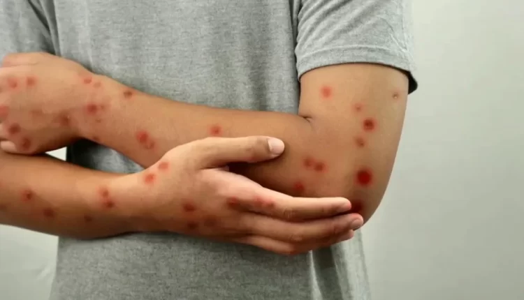 منظمة الصحة العالمية ترخص أول لقاح لجدري القردة للأطفال في ترتيبات جديدة لمكافحة الفيروس