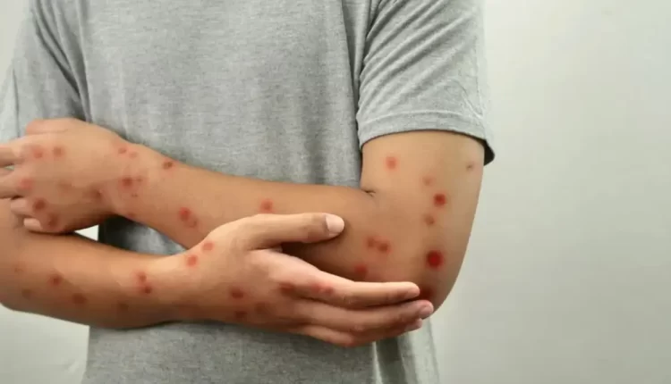 مديرية التعليم بتطوان تصدر مذكرة لمكافحة داء الحصبة في المدارس