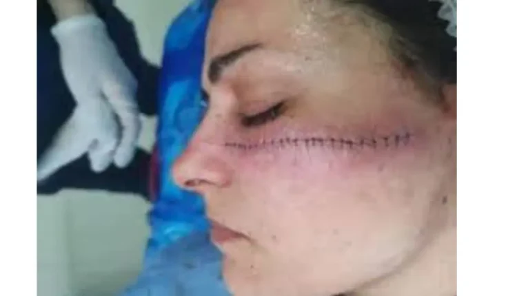 تشويه الوجه: عقوبات مخففة تعكس خللاً تشريعياً في المغرب