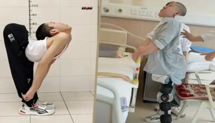 "الطفل ذو الظهر المثني" يُلهم الصين بعد نجاح 4 عمليات أعادت إليه استقامة جسده